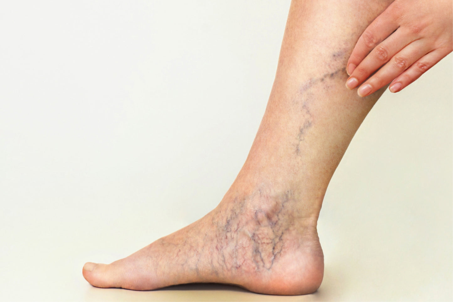 SPIDER VEINS TREATMENT